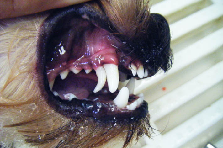 Zahnstein bei überzähligen Zähnen - Behandlung